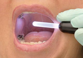 Oral cancer screening